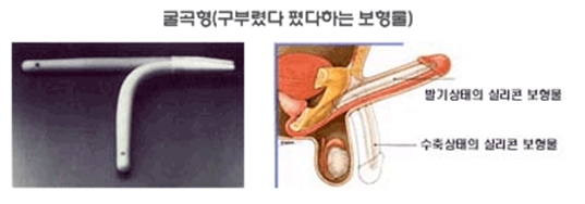 팽창형 사진
