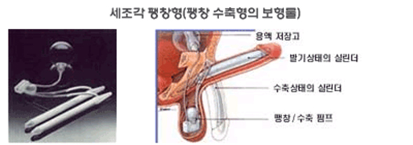 팽창형 사진